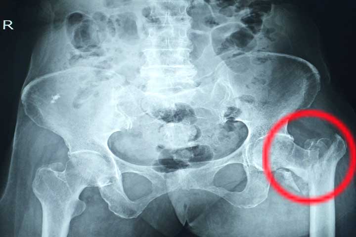 جراحة العظام في ألمانيا