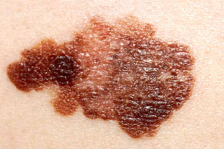 استئصال الأورام الجلدية في ألمانيا استئصال الأورام الجلدية في ألمانيا