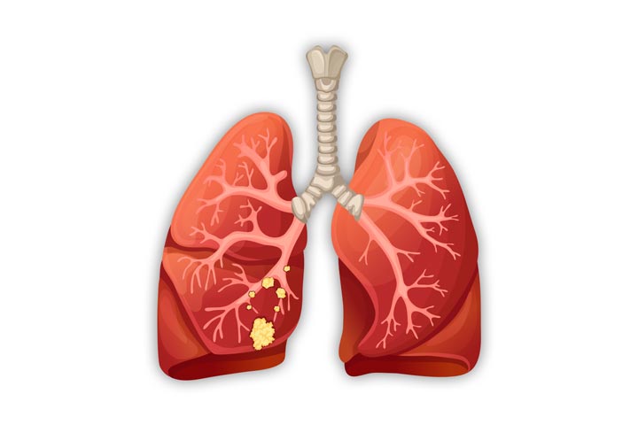 علاج أورام الرئة في ألمانيا علاج أورام الرئة في ألمانيا